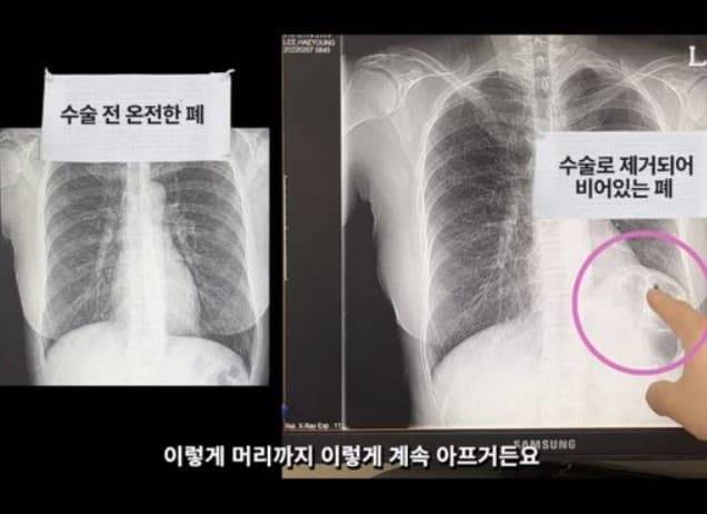 배우 이혜영 폐암 투병