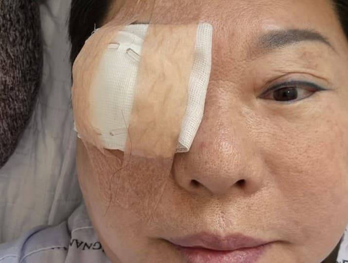 양희은 각막이식수술